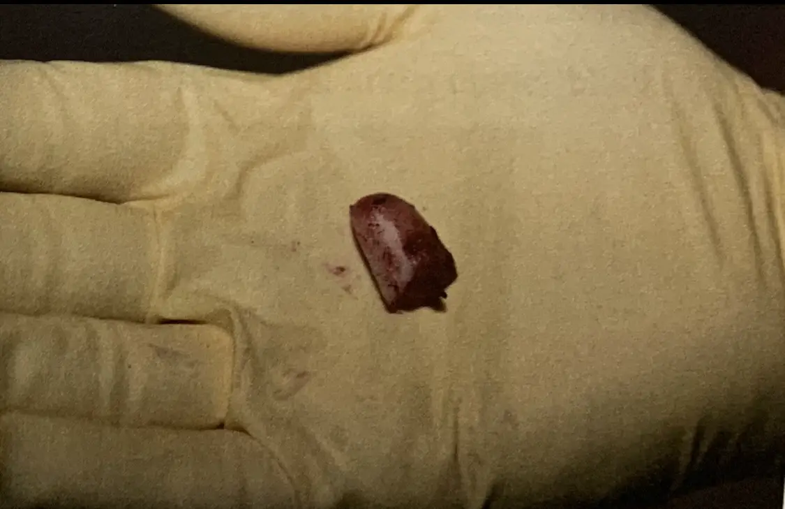 A photo of defendant Kellon Razdan's severed pinky finger left at the scene where 20-year-old Aris Keshishian was fatally stabbed in August 2021 near his San Marcos home. Photo courtesy of the San Diego County Sheriff’s Department