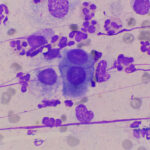 Mesothelioma is a cancer that develops from the mesothelial cells, above, which form a protective layer called the mesothelium covering the organs in the chest, abdomen, and around the heart. Courtesy photo