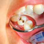 advances in technology using lasers and ozone make long-term success with root canals and re-treatment more viable. Stock photo